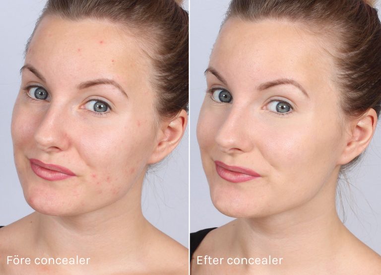 Cover pimples with duo concealer!