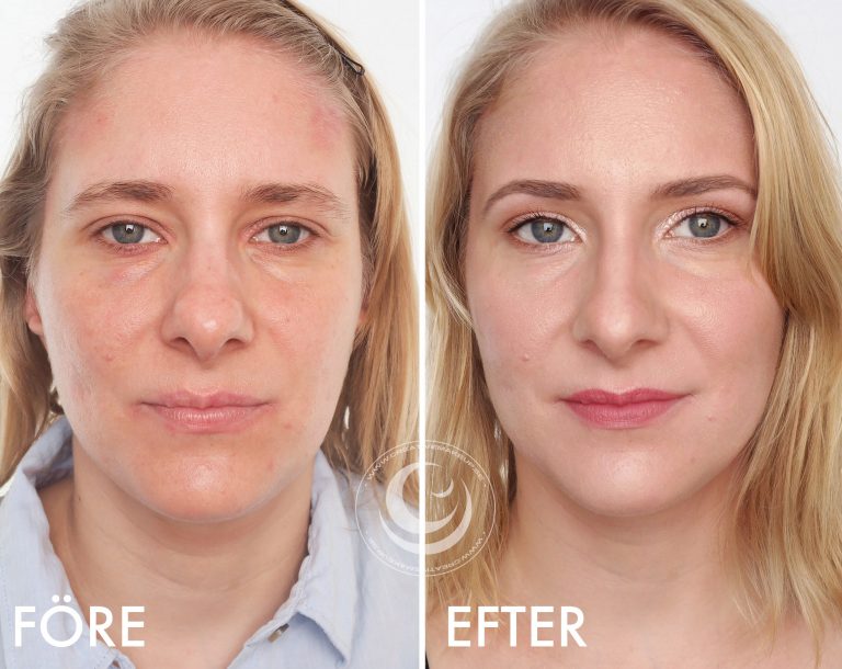 Maquillaje enrojecimiento antes y después