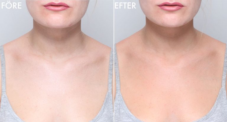 Protección solar y bronceador en el escote