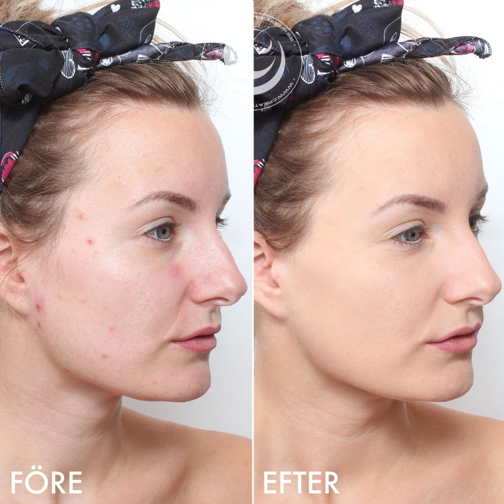 make up pimples before and after