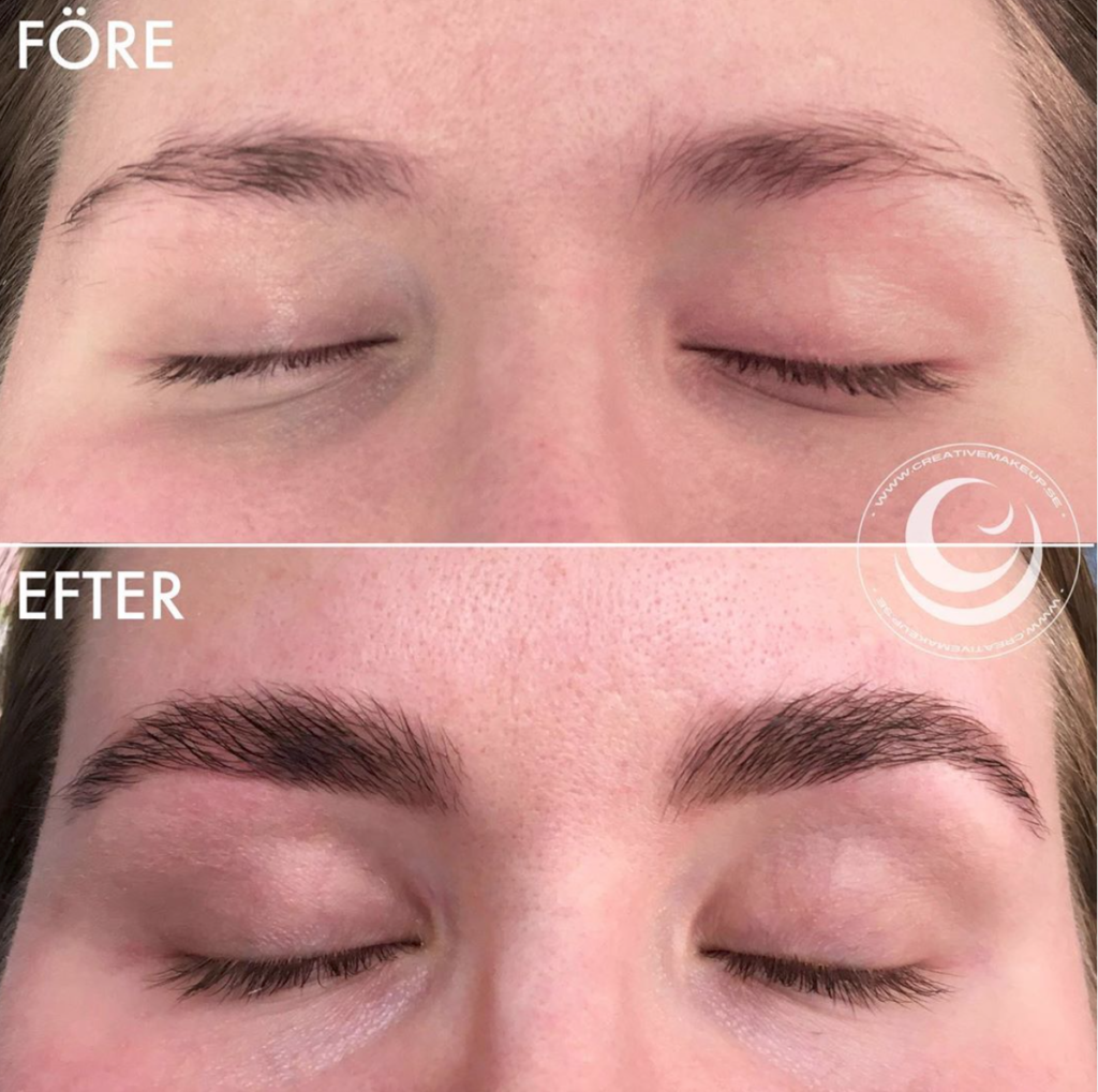 before and after brow lift