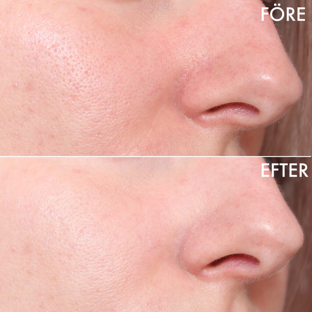 Reducir el enrojecimiento del rostro antes y después.